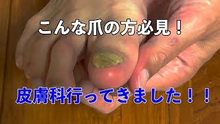 【爪水虫治療レポ】10年放置したボロボロの爪…皮膚科に行ったら爪を剥がされずに済みました！費用と治療法を公開
